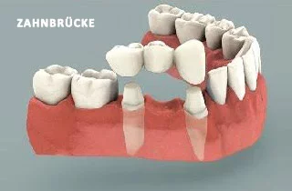 Zahnbruecke-oder-Implantat