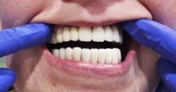 Zahnimplantat Minilift Erfahrungsberichte