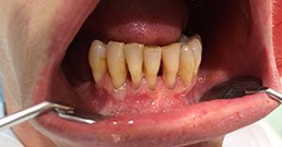 Zahnimplantat Knochenaufbau Erfahrungsberichte