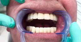 Implantate Zahn Erfahrungen