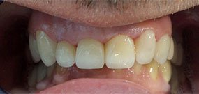 Zähne überkronen vorher und nachher