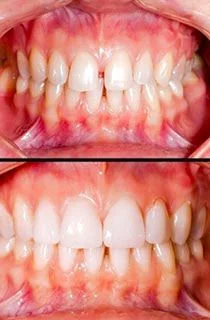 no prep veneers vorher nacher